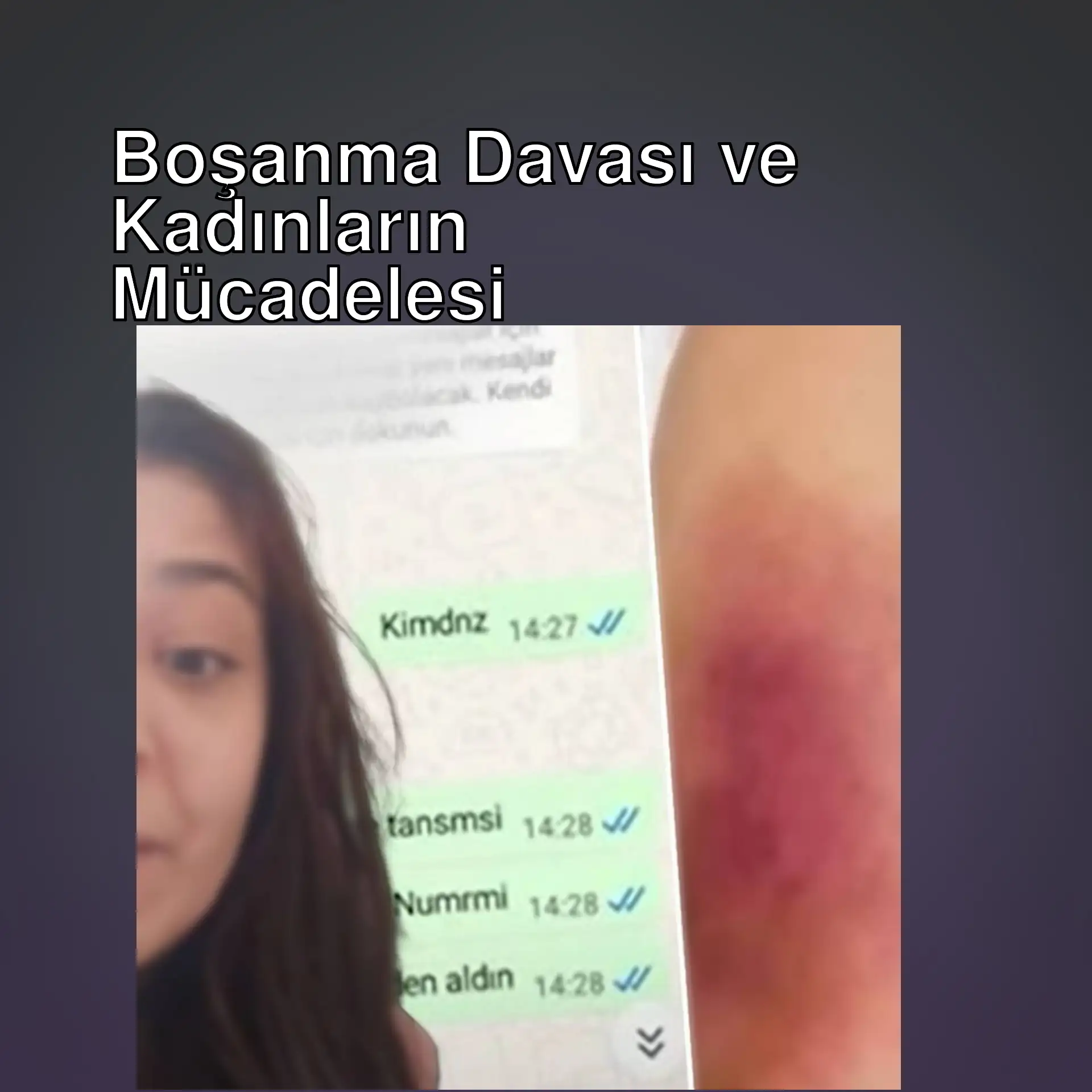 Bir kadının kolundaki morluk. Bir kadının kolundaki morluk.
