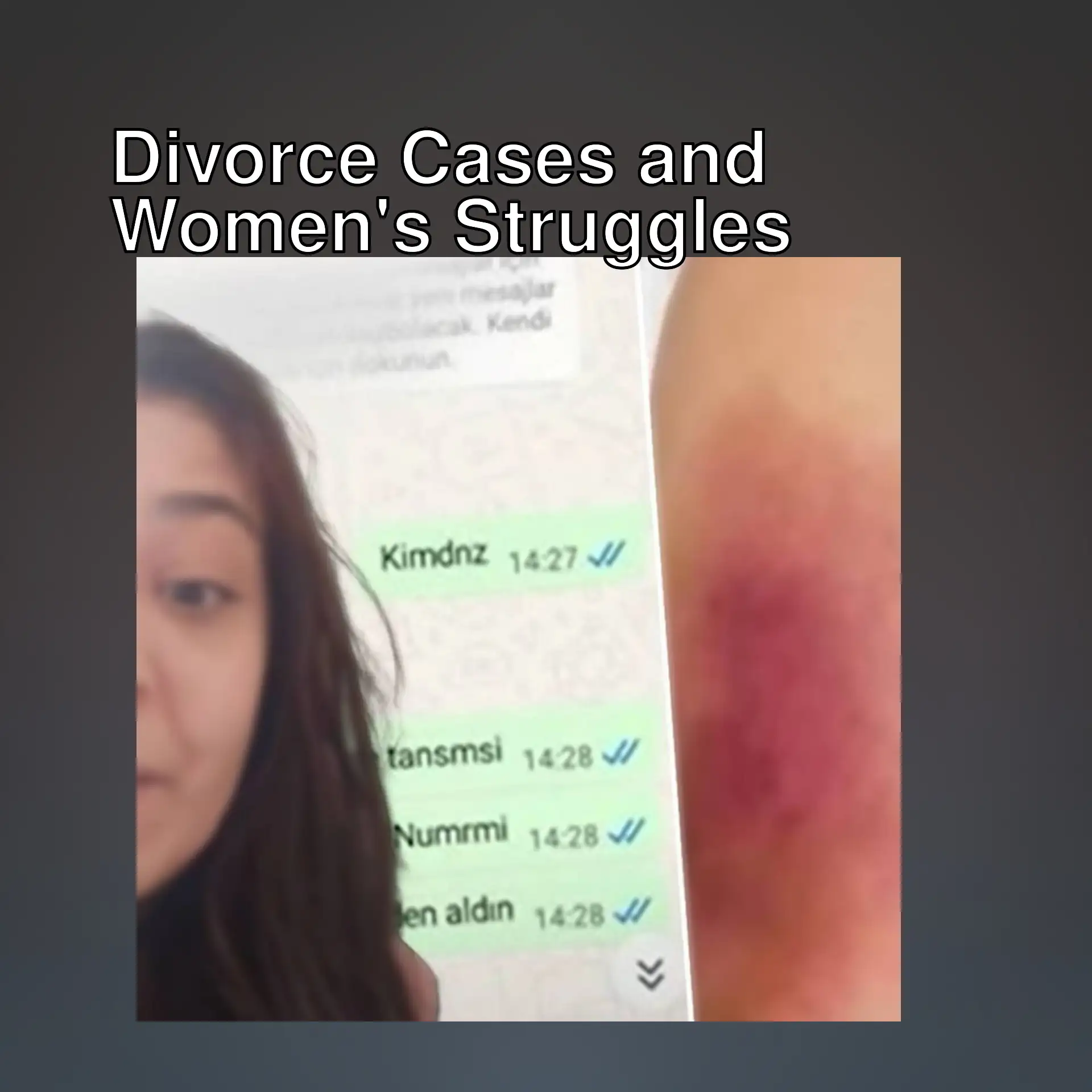 A woman with a bruise on her arm. A woman with a bruise on her arm.